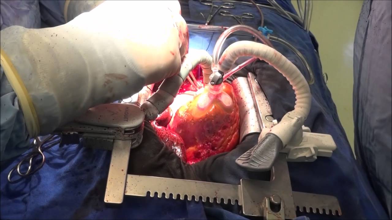 Açık Kalp Ameliyatı Nedir? Nasıl Yapılır?